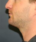 Feel Beautiful - chin implant neck lipo - After Photo
